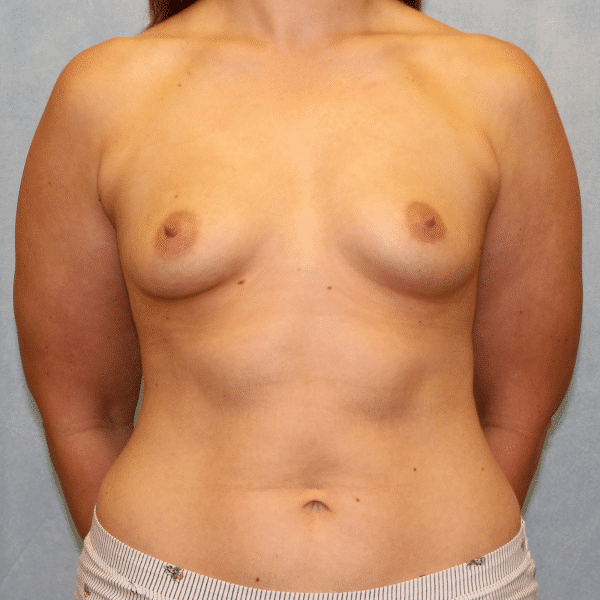 Case #2309 – Breast Augmentation