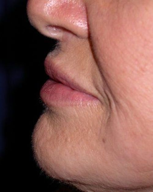 After Image: Case #237 – Fat Grafting - left-side