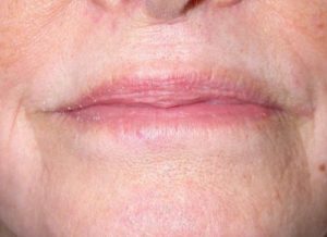 Case #237 – Fat Grafting