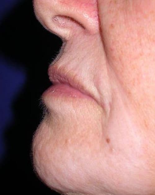 Before Image: Case #237 – Fat Grafting - left-side