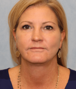 Case #2402 – Facelift