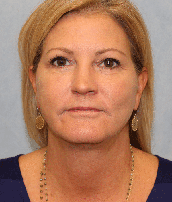 After Image: Case #2402 – Facelift - front