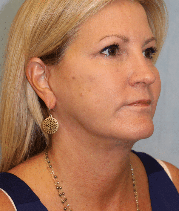 After Image: Case #2402 – Facelift - right-front-oblique