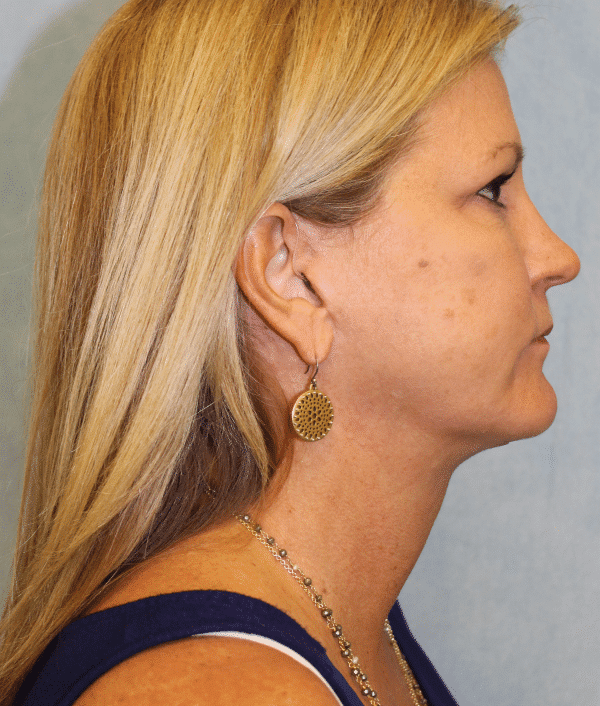 After Image: Case #2402 – Facelift - right-side