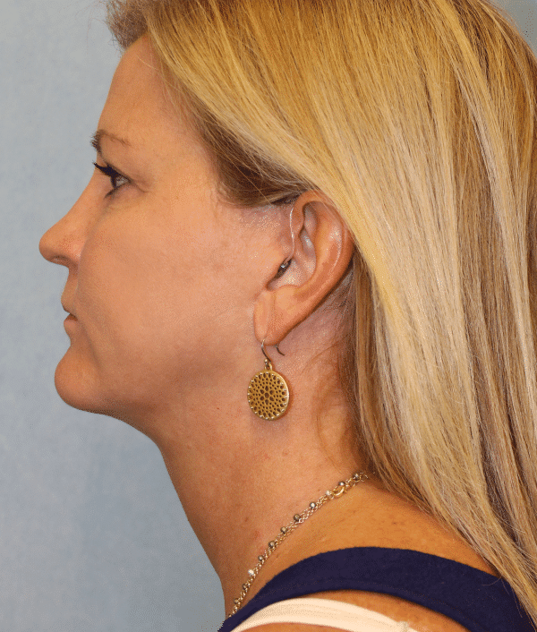 After Image: Case #2402 – Facelift - left-side