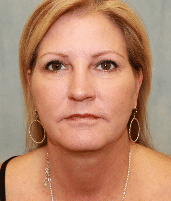 Before Image: Case #2402 – Facelift - front