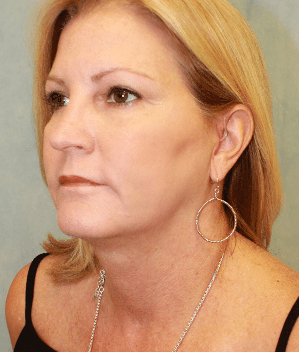 Before Image: Case #2402 – Facelift - left-front-oblique