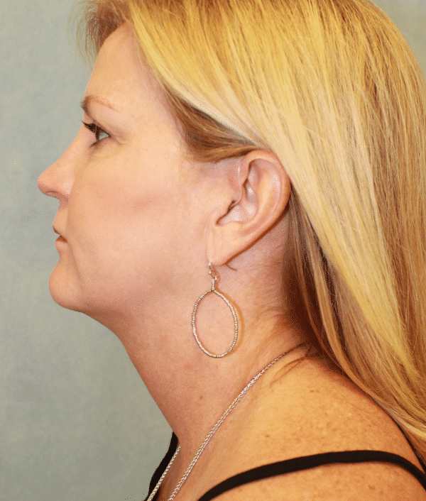 Before Image: Case #2402 – Facelift - left-side