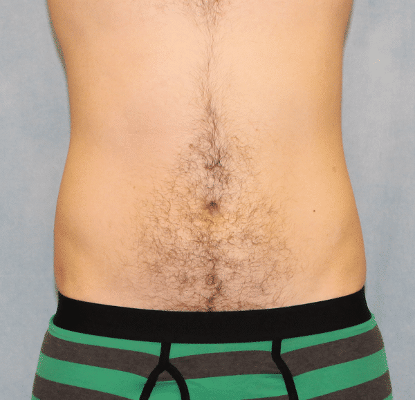 After Image: Case #2415 – Liposuction - front