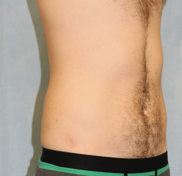 After Image: Case #2415 – Liposuction - right-front-oblique