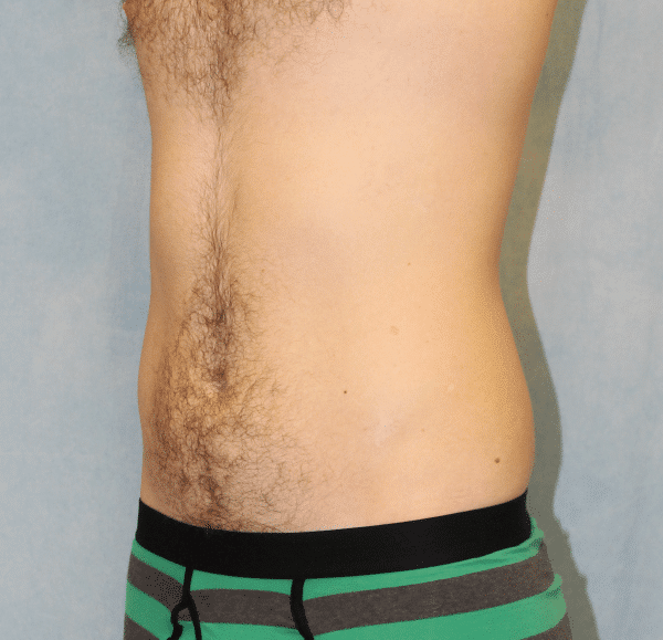 After Image: Case #2415 – Liposuction - left-front-oblique