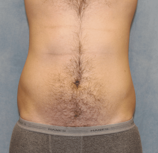 Case #2415 – Liposuction