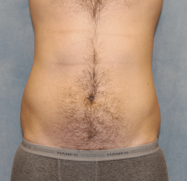 Before Image: Case #2415 – Liposuction - front