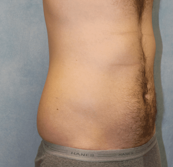 Before Image: Case #2415 – Liposuction - right-front-oblique