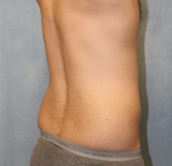 Before Image: Case #2415 – Liposuction - right-back-oblique