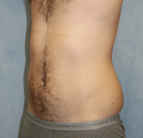 Before Image: Case #2415 – Liposuction - left-front-oblique