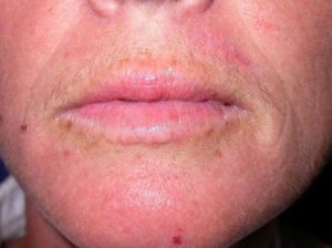 Case #247 – Fat Grafting