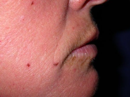 After Image: Case #247 – Fat Grafting - right-side