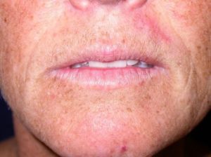 Case #247 – Fat Grafting