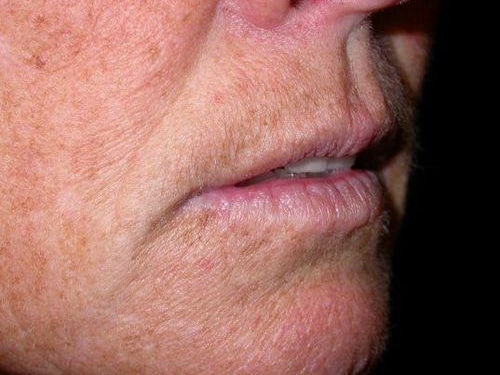 Before Image: Case #247 – Fat Grafting - right-front-oblique