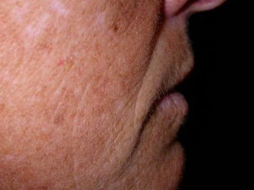 Before Image: Case #247 – Fat Grafting - right-side