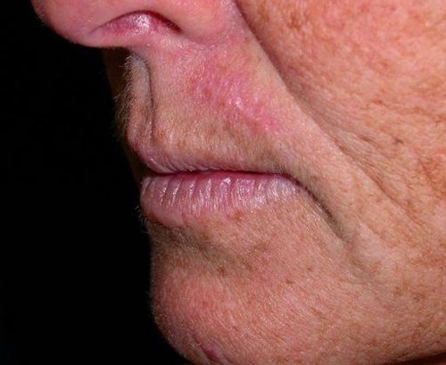 Before Image: Case #247 – Fat Grafting - left-front-oblique