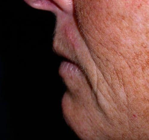 Before Image: Case #247 – Fat Grafting - left-side