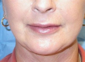 Case #259 – Fat Grafting