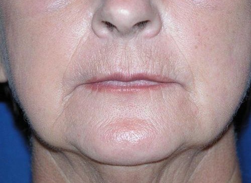 Before Image: Case #259 – Fat Grafting - front