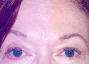 Case #267 – Fat Grafting