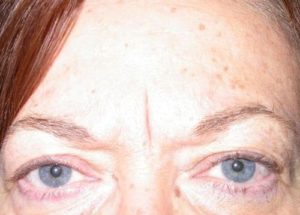 Case #267 – Fat Grafting