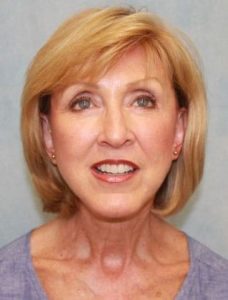 Case #271 – Facelift