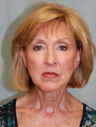 Before Image: Case #271 – Facelift - front