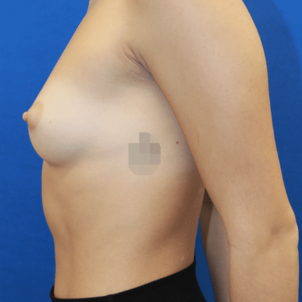 Before Image: Case #2867 – Breast Augmentation - left-side