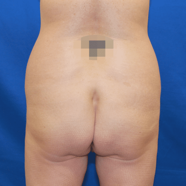 Case #2884 – Brazilian Butt Lift