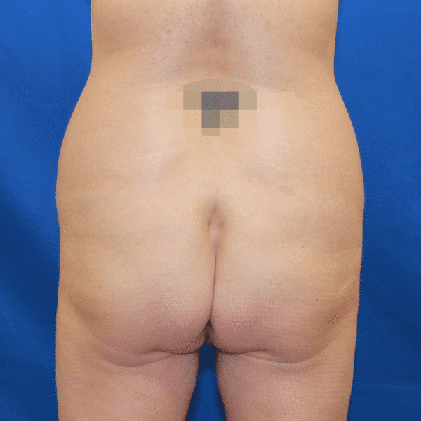 Before Image: Case #2884 – Brazilian Butt Lift - back