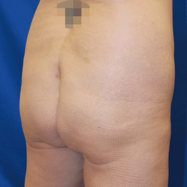 Before Image: Case #2884 – Brazilian Butt Lift - right-back-oblique