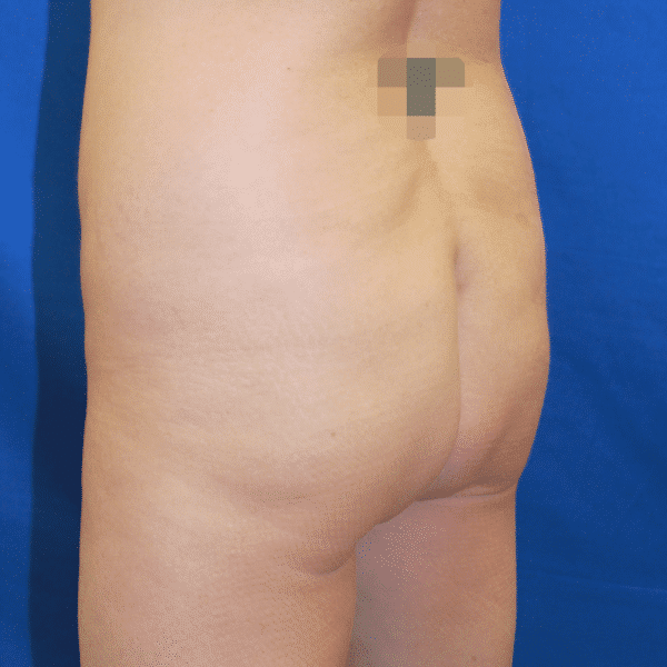Before Image: Case #2884 – Brazilian Butt Lift - left-back-oblique
