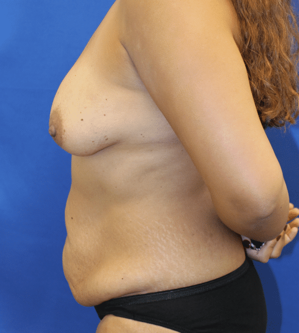 Before Image: Case #2895 – Mommy Makeover - left-side