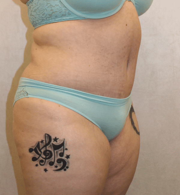 After Image: Case #2923 – Abdominoplasty + Monsplasty - right-front-oblique