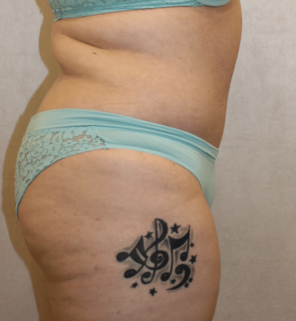 After Image: Case #2923 – Abdominoplasty + Monsplasty - right-side