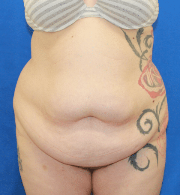 Before Image: Case #2923 – Abdominoplasty + Monsplasty - front