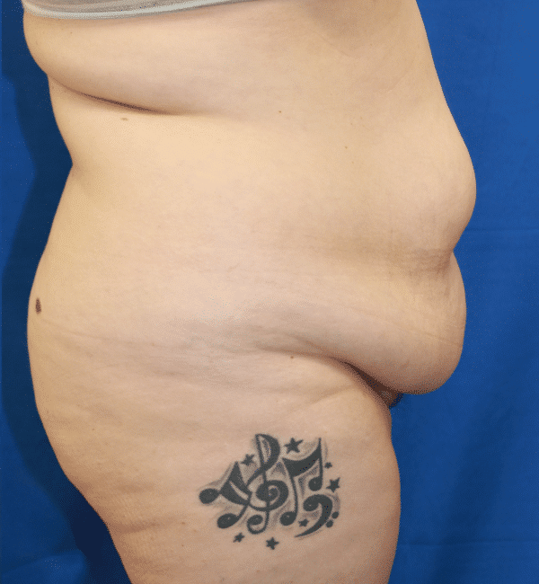Before Image: Case #2923 – Abdominoplasty + Monsplasty - right-side
