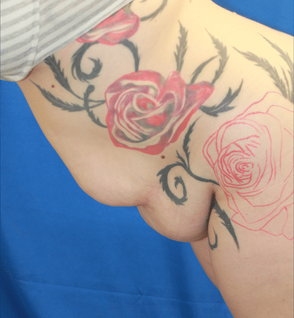 Before Image: Case #2923 – Abdominoplasty + Monsplasty - left-front-oblique