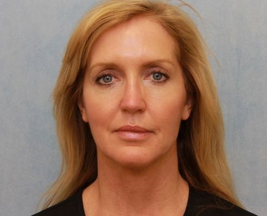 After Image: Case #297 – Facelift - front