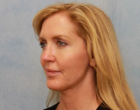 After Image: Case #297 – Facelift - left-front-oblique
