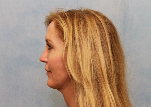 After Image: Case #297 – Facelift - left-side