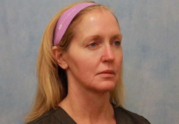 Before Image: Case #297 – Facelift - right-front-oblique