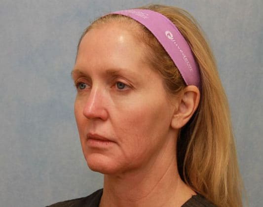 Before Image: Case #297 – Facelift - left-front-oblique