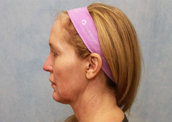 Before Image: Case #297 – Facelift - left-side